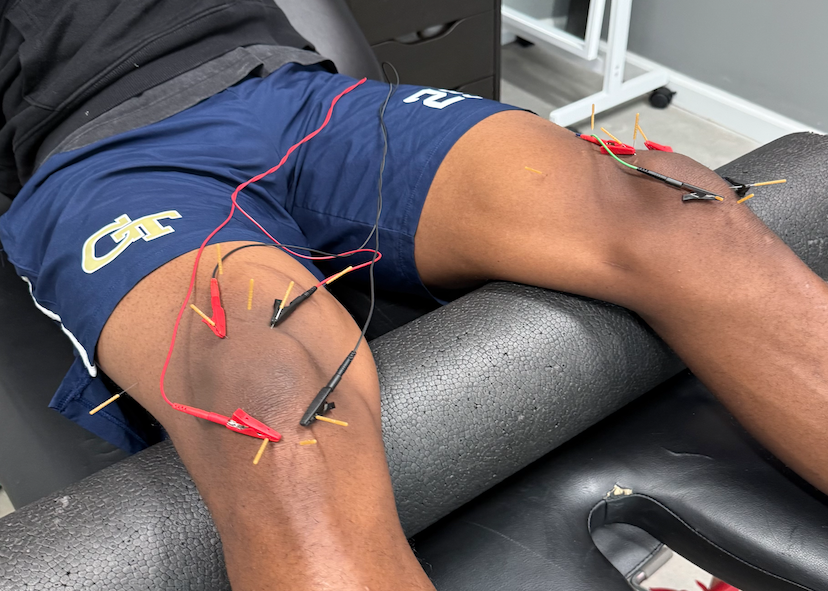 Athlete getting dry needling for patellar tendinitis